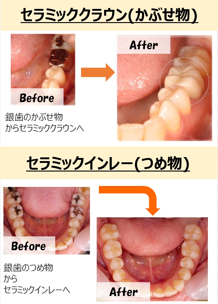 【むしば治療】セラミック治療のメリット